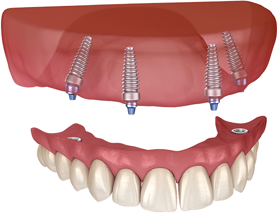 all on 4 dental implants model