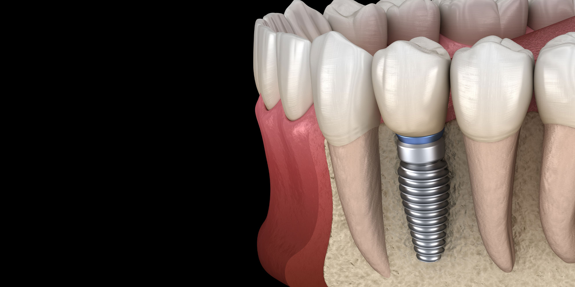 bone grafting for dental implants