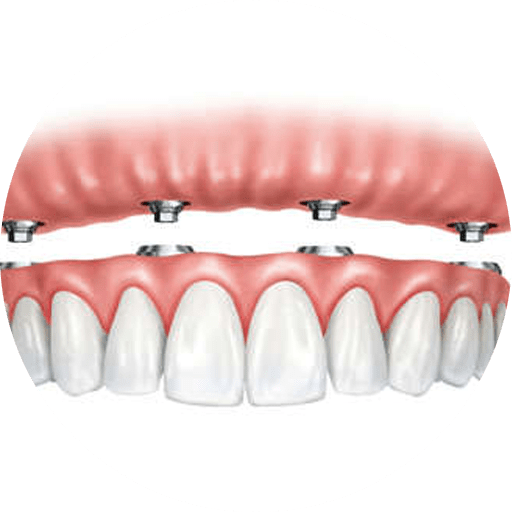 implant supported dentures graphic