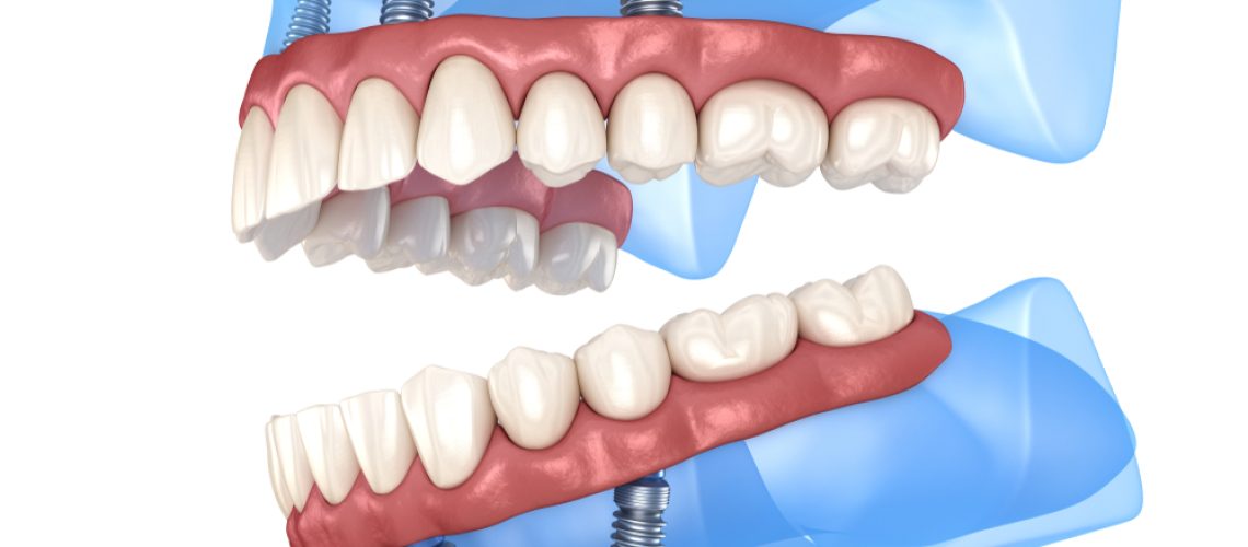 3D view of All on 4 Implants