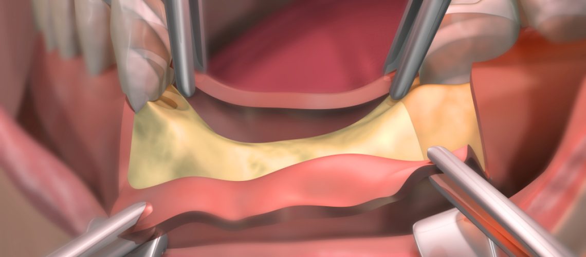 bone grafting for dental implants