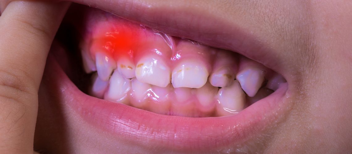 gum disease treatment options
