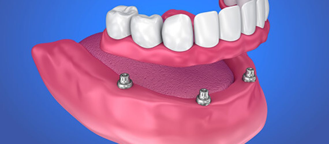 Image showing a lower set of dentures and the four dental implant posts.