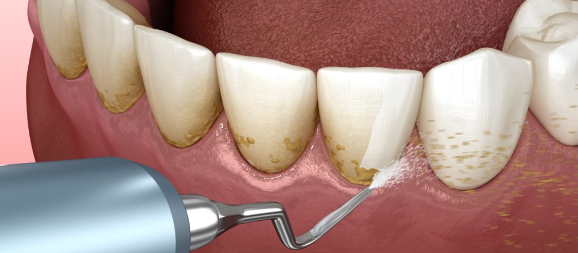 scaling and root planing
