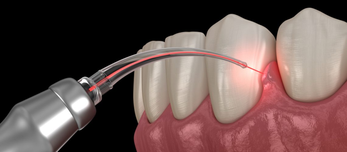 A laser dentistry treatment