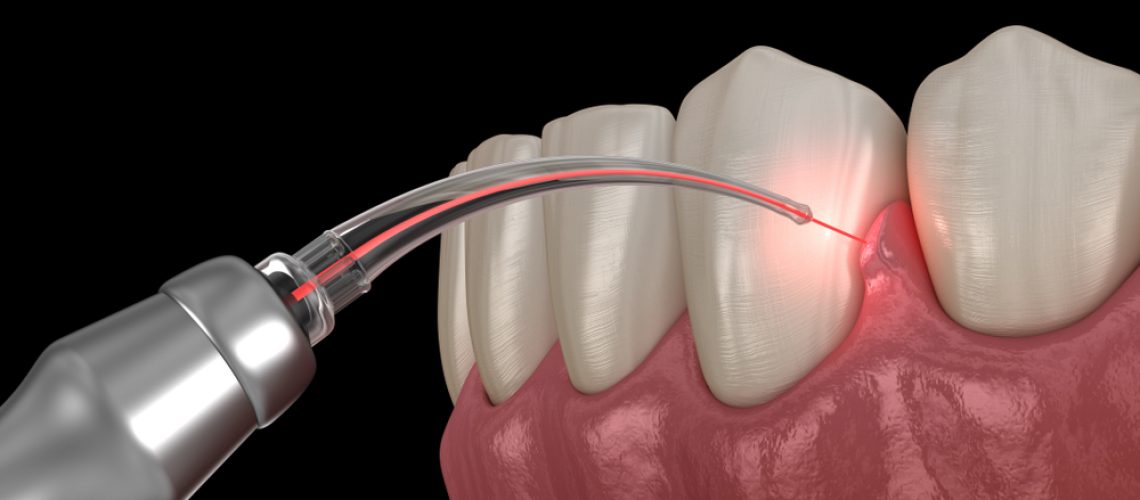 A laser dentistry treatment